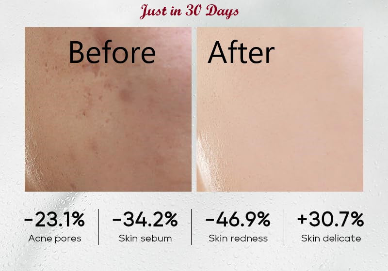 ÉDEN Original Acne-Clear Skincare Set – Blemish & Acne Treatment Kit