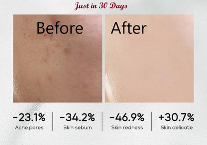 ÉDEN Original Acne-Clear Skincare Set – Blemish & Acne Treatment Kit