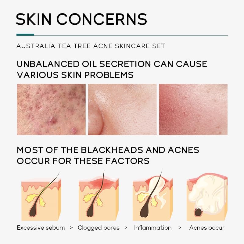 ÉDEN Original Acne-Clear Skincare Set – Blemish & Acne Treatment Kit