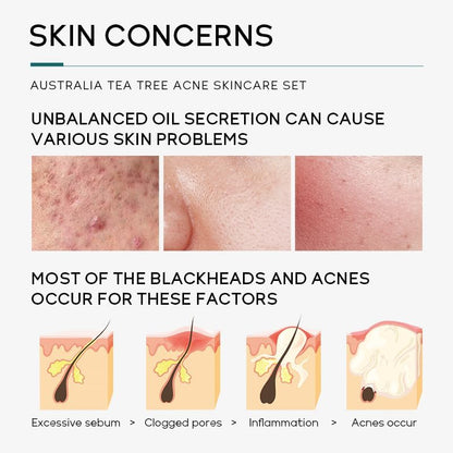 ÉDEN Original Acne-Clear Skincare Set – Blemish & Acne Treatment Kit